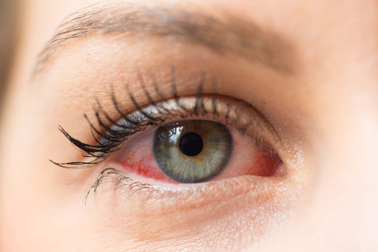 Close-up of a red, irritated eye with visible redness from eye allergy symptoms.