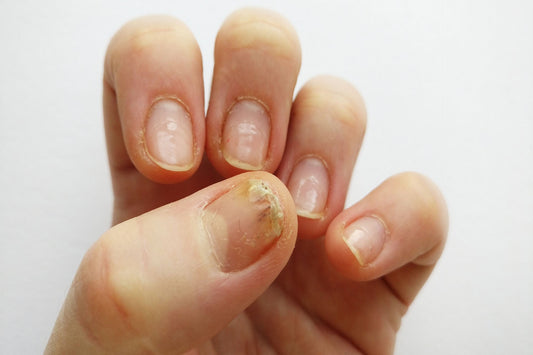 Close-up of a hand showing fingernails with damage and lifting at the nail tips against a white background.